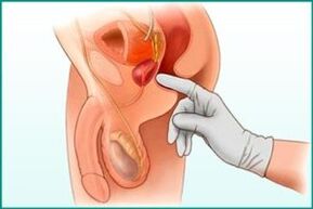 Palpation of the prostate