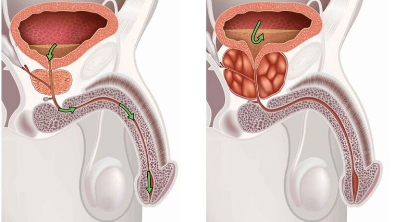 healthy and inflamed prostate gland with prostatitis